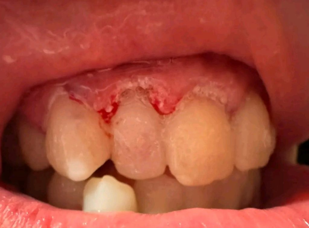 Celebrity make-up artist devastated after discovering the 24 crowns she got in Turkey were actually 16 teeth joined together as bridges - now facing up to £15,000 to fix it.