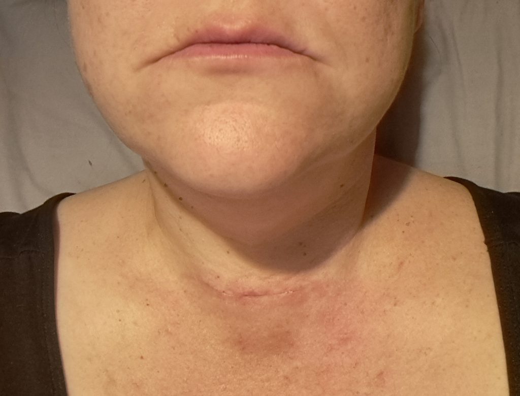 A British mum who blacked out on a flight was diagnosed with epilepsy - then a rare genetic disorder affecting fewer than 100 people worldwide behind her seizures.