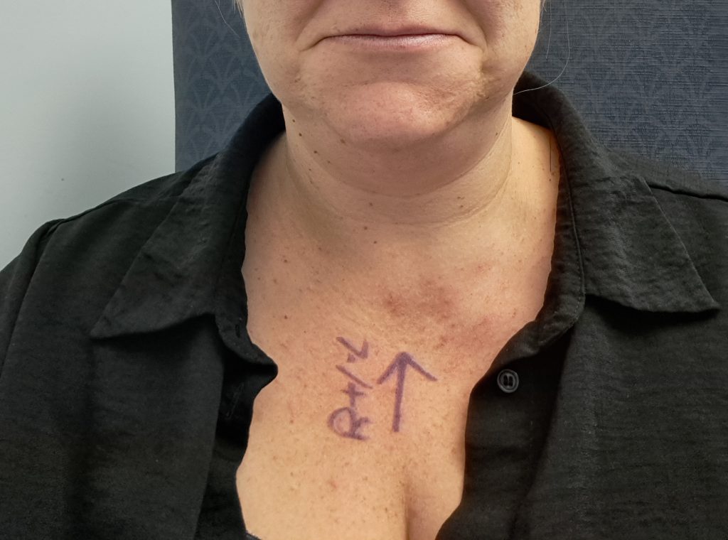A British mum who blacked out on a flight was diagnosed with epilepsy - then a rare genetic disorder affecting fewer than 100 people worldwide behind her seizures.
