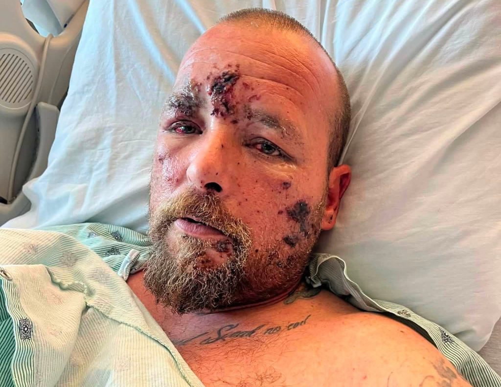 Dad has his hand blown off after picking up a "bomb-like" device while cleaning firework rubbish from a beach, also suffering vision and hearing loss.