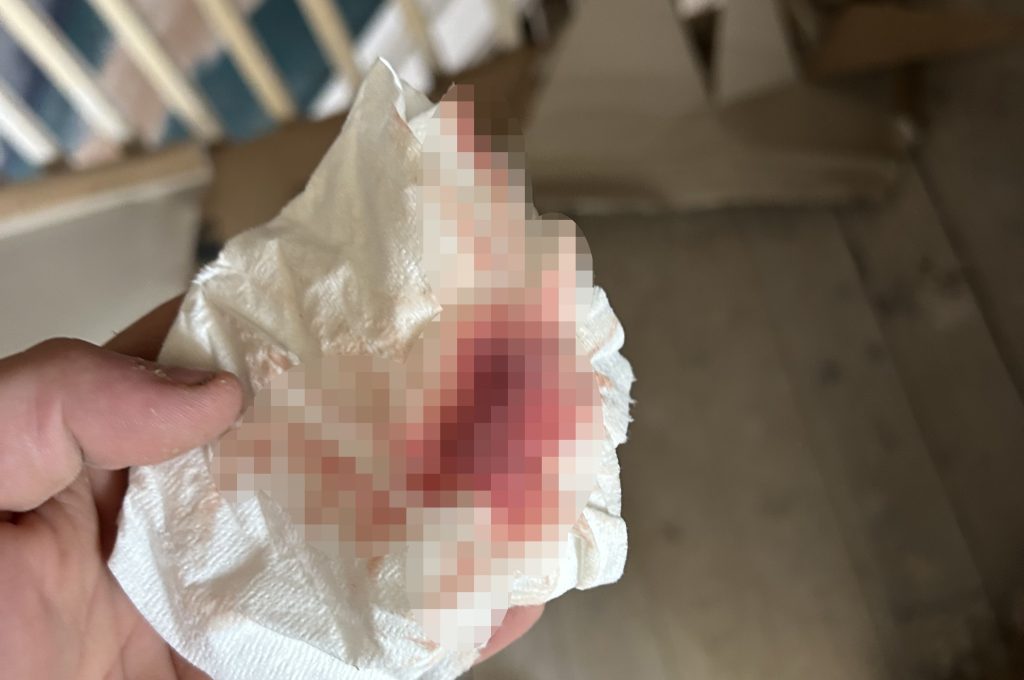 Handyman, 25, left housebound for months after a mystery pain in his bum turned out to be a huge abscess that finally burst, needing emergency surgery.