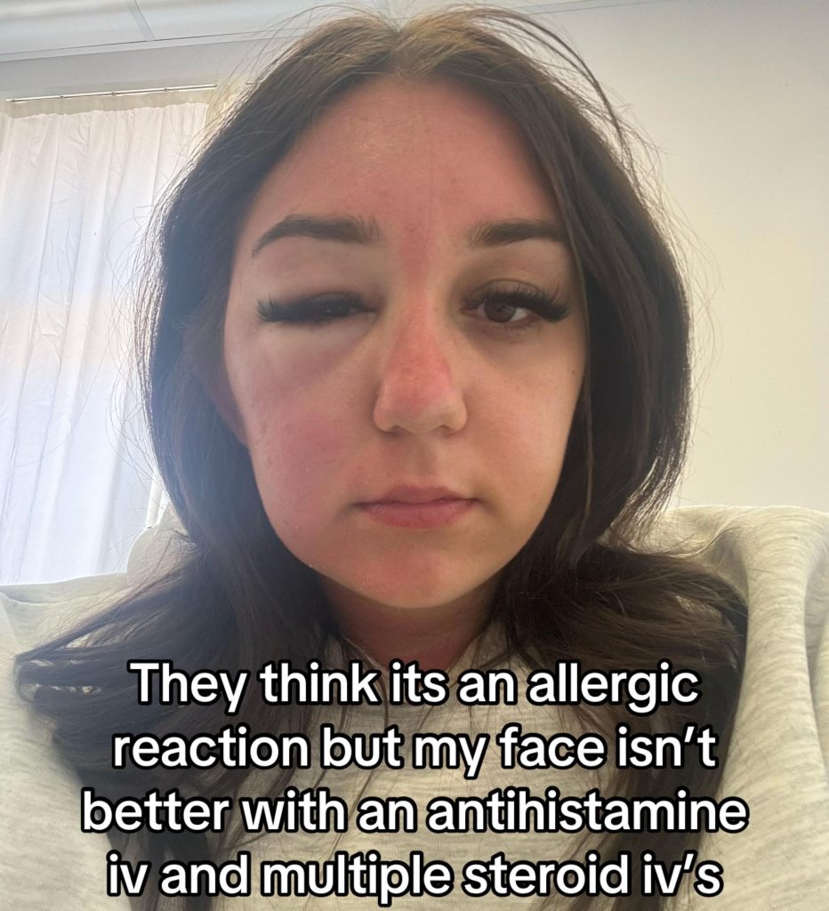 A young woman's holiday turned to horror when her "eye bags" turned out to be a mystery infection that left her hospitalised in Greece and unable to fly home for days.