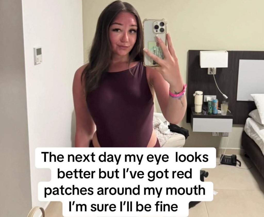 A young woman's holiday turned to horror when her "eye bags" turned out to be a mystery infection that left her hospitalised in Greece and unable to fly home for days.