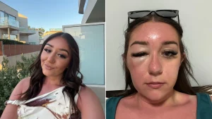 A young woman's holiday turned to horror when her "eye bags" turned out to be a mystery infection that left her hospitalised in Greece and unable to fly home for days.