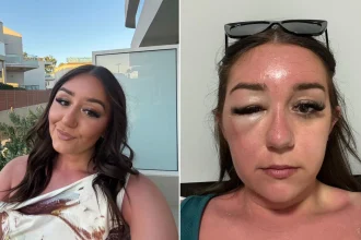 A young woman's holiday turned to horror when her "eye bags" turned out to be a mystery infection that left her hospitalised in Greece and unable to fly home for days.