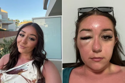 A young woman's holiday turned to horror when her "eye bags" turned out to be a mystery infection that left her hospitalised in Greece and unable to fly home for days.