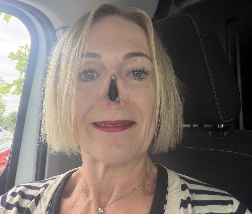Woman who lost her nose to a rare autoimmune disease after her dog headbutted her says she is determined to stop it happening to others - and believes the pet may have saved her life.