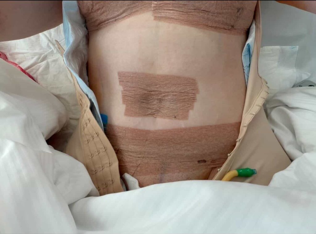 Woman who used "skinny jabs" to beat her shopping addiction was left with the "body of an 80-year-old" - and forked out £10,000 on surgery so she can wear a bikini.