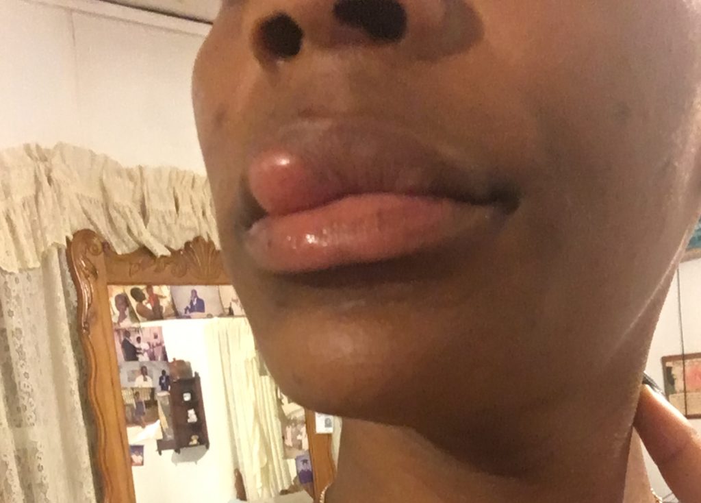 Woman with an ultra-rare water allergy says even her own tears leave her in agony - she can only wash her face once a month and can't drink plain water without feeling sick.