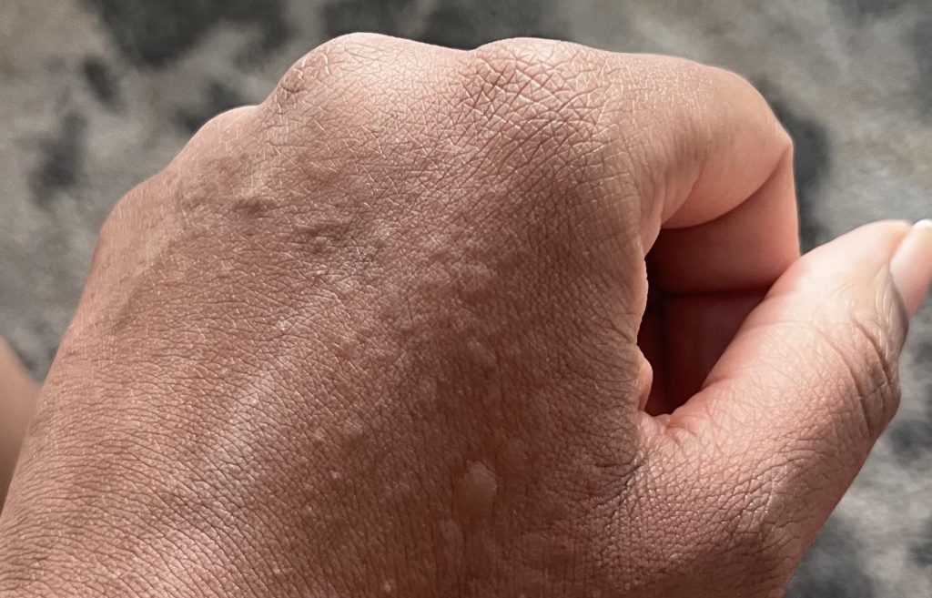Woman with an ultra-rare water allergy says even her own tears leave her in agony - she can only wash her face once a month and can't drink plain water without feeling sick.