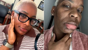 Woman with an ultra-rare water allergy says even her own tears leave her in agony - she can only wash her face once a month and can't drink plain water without feeling sick.