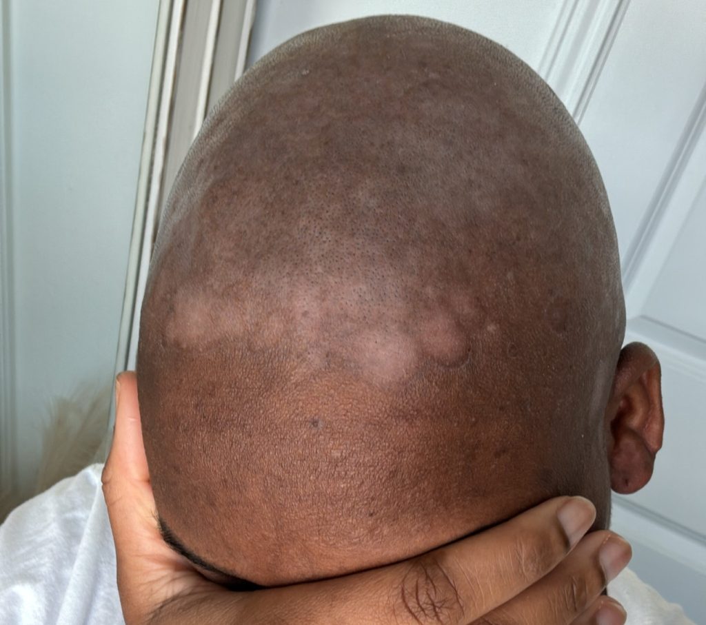 Woman with an ultra-rare water allergy says even her own tears leave her in agony - she can only wash her face once a month and can't drink plain water without feeling sick.