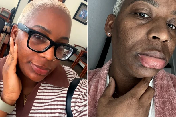 Woman with an ultra-rare water allergy says even her own tears leave her in agony - she can only wash her face once a month and can't drink plain water without feeling sick.
