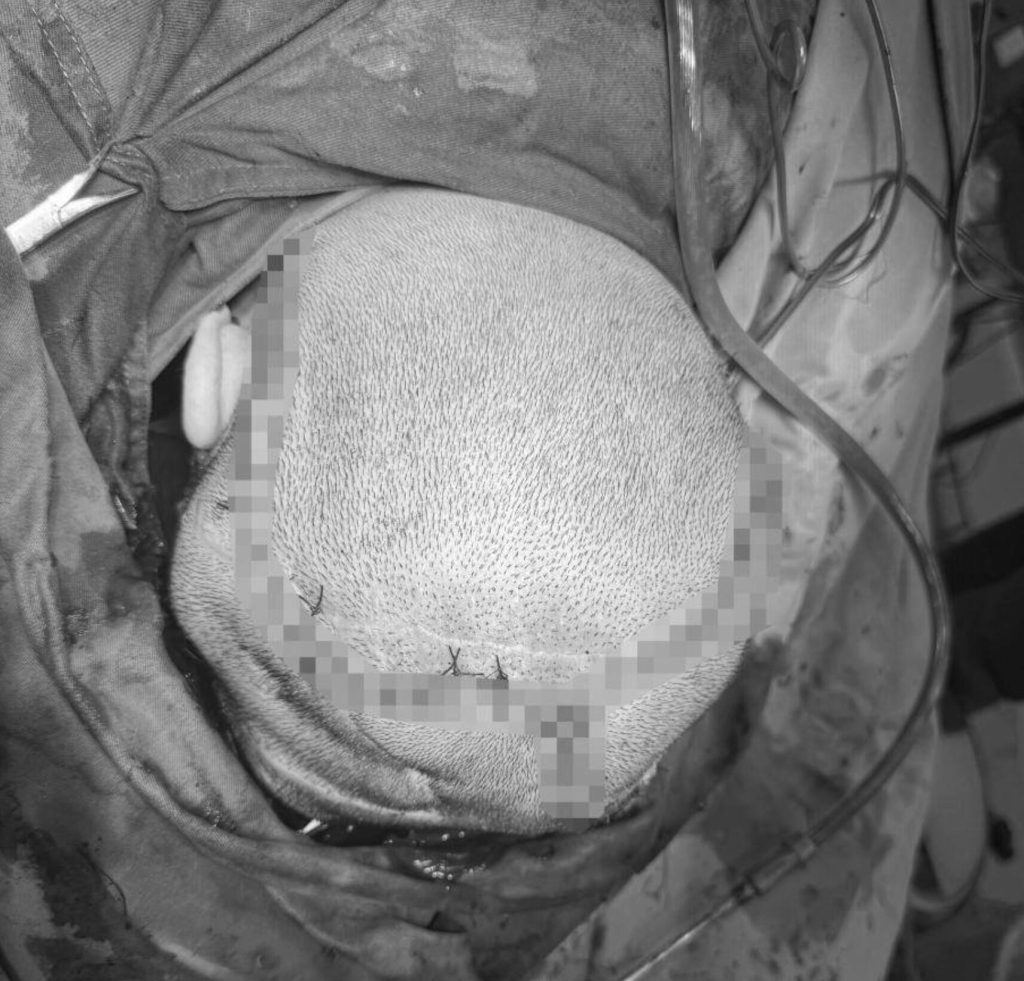 Man whose scalp thickened into deep folds resembling a human brain has his head restored to normal after an epic 11-month skin expansion procedure at a hospital in China.