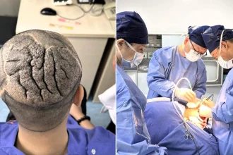 Man whose scalp thickened into deep folds resembling a human brain has his head restored to normal after an epic 11-month skin expansion procedure at a hospital in China.