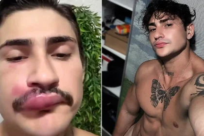 Brazilian model nearly dies after squeezing pimple in face's 'death zone.' Dermatologist explains the hidden infection risk between eyebrows and mouth.