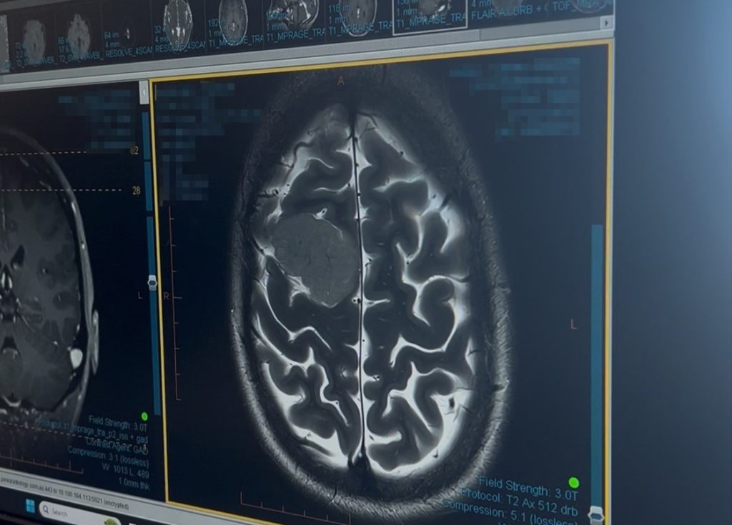Paramedic and circus performer dismissed strange noises in her ear as stress for three years - then a scan revealed a huge 4cm brain tumour that changed her whole outlook on life.
