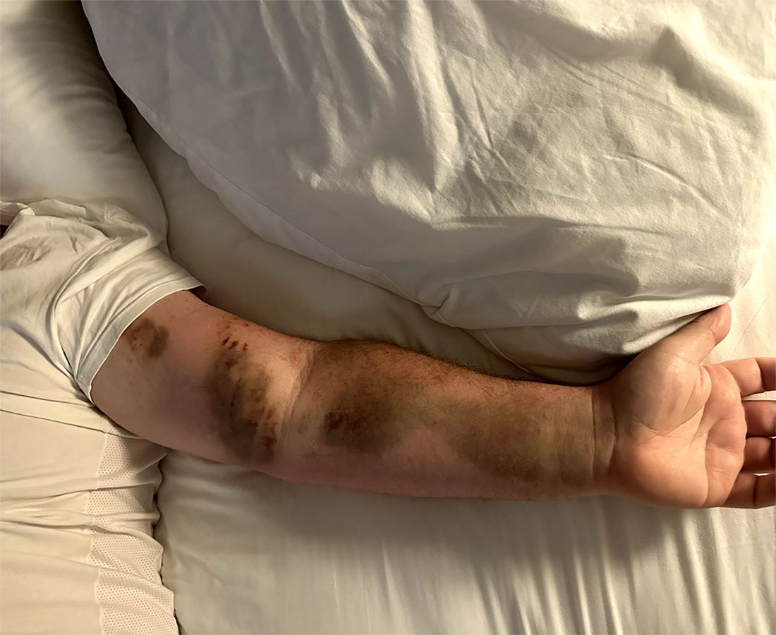 A dad bitten twice by a rattlesnake needed 54 vials of anti-venom to survive - now his family face a staggering $1.3million hospital bill after the ordeal.