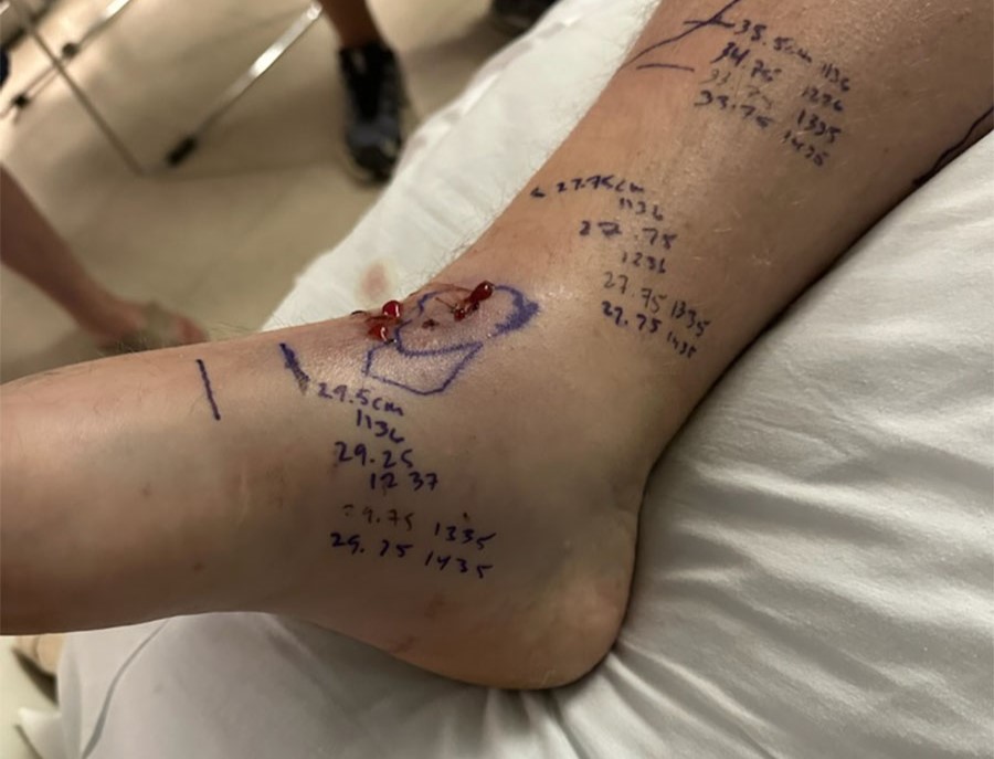A dad bitten twice by a rattlesnake needed 54 vials of anti-venom to survive - now his family face a staggering $1.3million hospital bill after the ordeal.