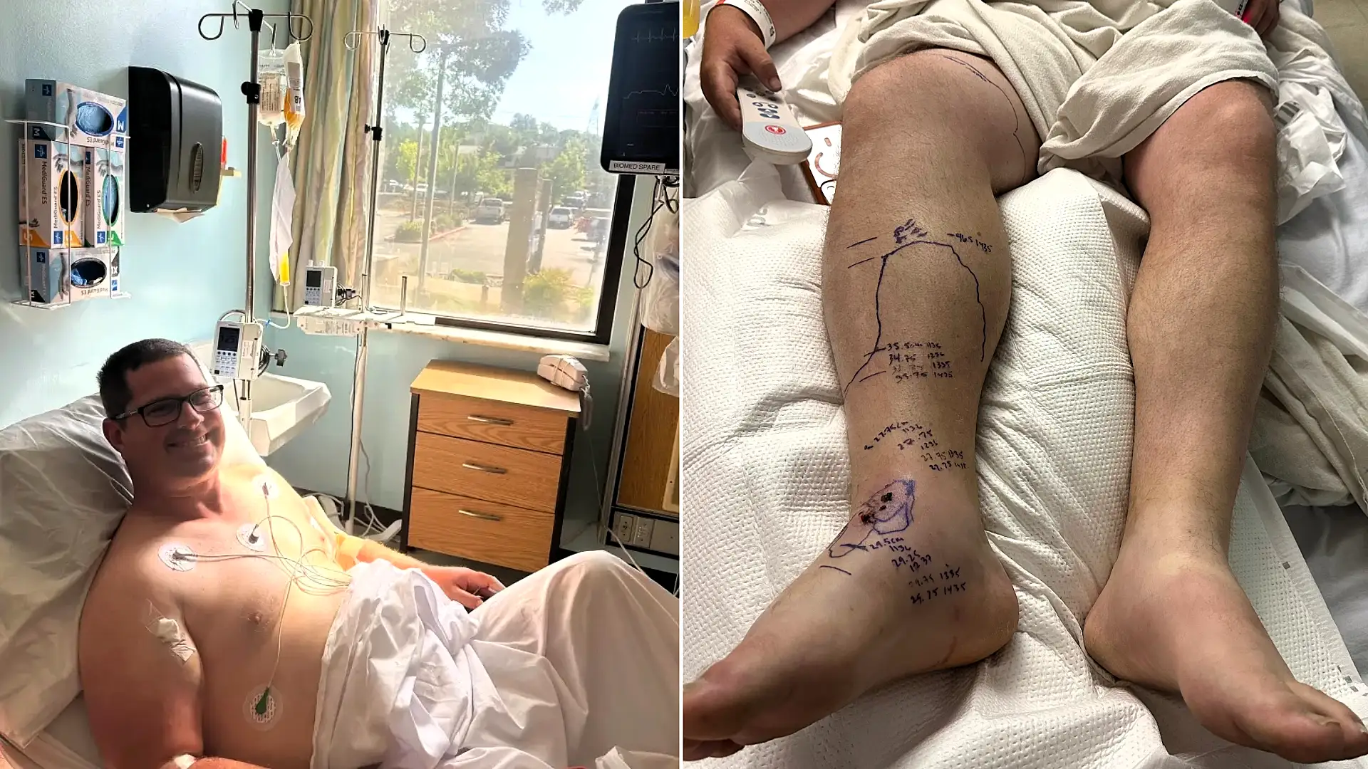 Rattlesnake bite victim given 54 doses of anti-venom - now faces £970,000 hospital bill