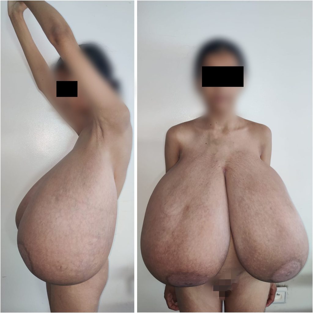 A teenage girl has been operated on after a rare condition caused her breasts to swell to over a quarter of her body weight - with 17lbs removed from each side.