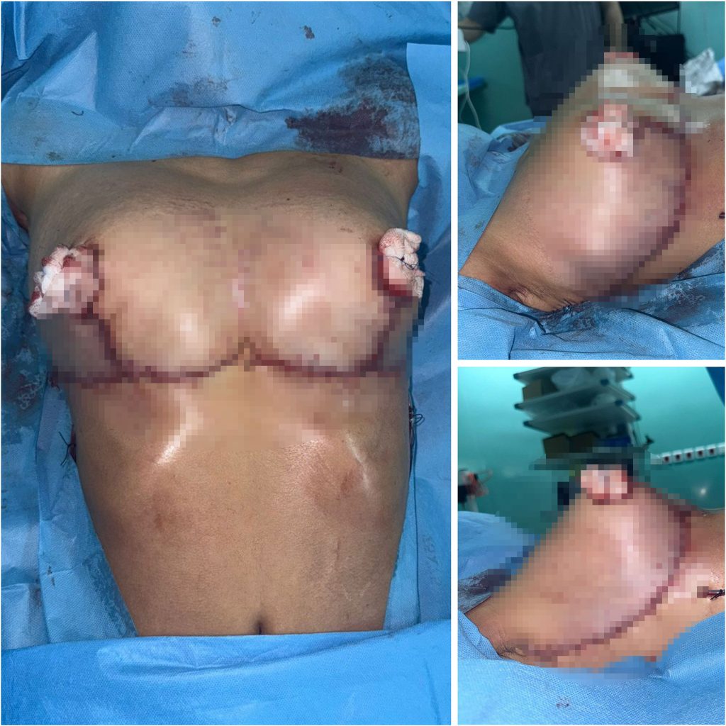 A teenage girl has been operated on after a rare condition caused her breasts to swell to over a quarter of her body weight - with 17lbs removed from each side.
