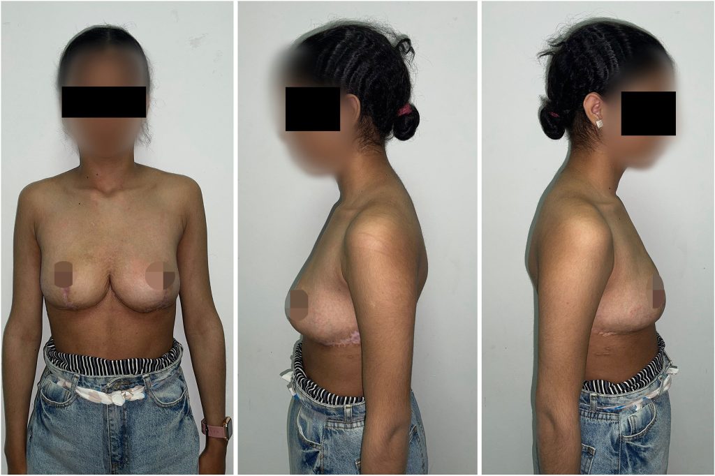 A teenage girl has been operated on after a rare condition caused her breasts to swell to over a quarter of her body weight - with 17lbs removed from each side.