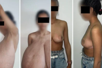 A teenage girl has been operated on after a rare condition caused her breasts to swell to over a quarter of her body weight - with 17lbs removed from each side.