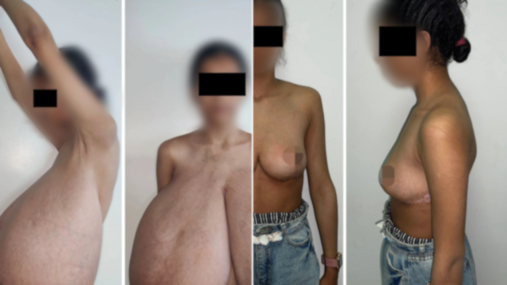 Teen girl has rare condition causing breasts to swell to QUARTER of entire body weight