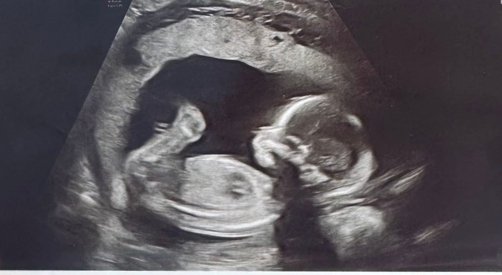 Mum-to-be who beat breast cancer against the odds says the double mastectomy that saved her life means she'll never breastfeed - so 20 women have offered to donate their milk.