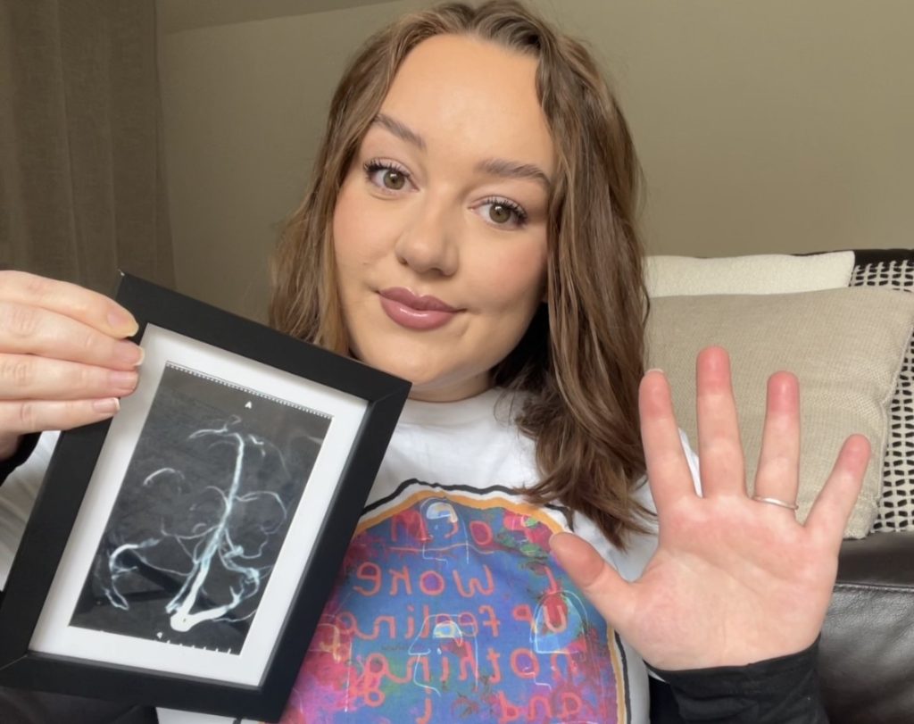 Woman with a week-long agonising migraine was 'fobbed off' by doctors as merely hungover - but she was actually having a stroke that went on to 'steal' her entire 20s.