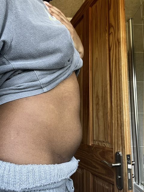 Woman told her symptoms were just stress nearly dies after a ruptured ovarian cyst triggers sepsis, with part of her bowel wrapped around a fallopian tube.