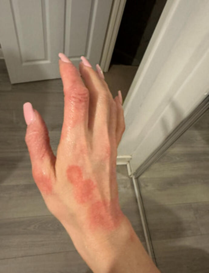 Bikini model prescribed a common eczema cream since childhood says topical steroid withdrawal has left her 'looking like Freddy Krueger' - bedbound, hospitalised and in agony.