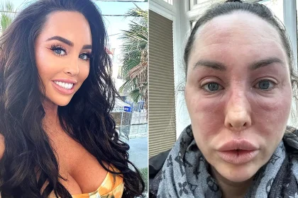 Bikini model prescribed a common eczema cream since childhood says topical steroid withdrawal has left her 'looking like Freddy Krueger' - bedbound, hospitalised and in agony.
