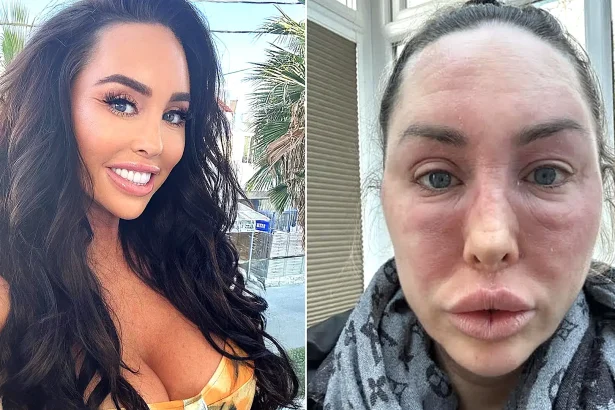 Bikini model prescribed a common eczema cream since childhood says topical steroid withdrawal has left her 'looking like Freddy Krueger' - bedbound, hospitalised and in agony.