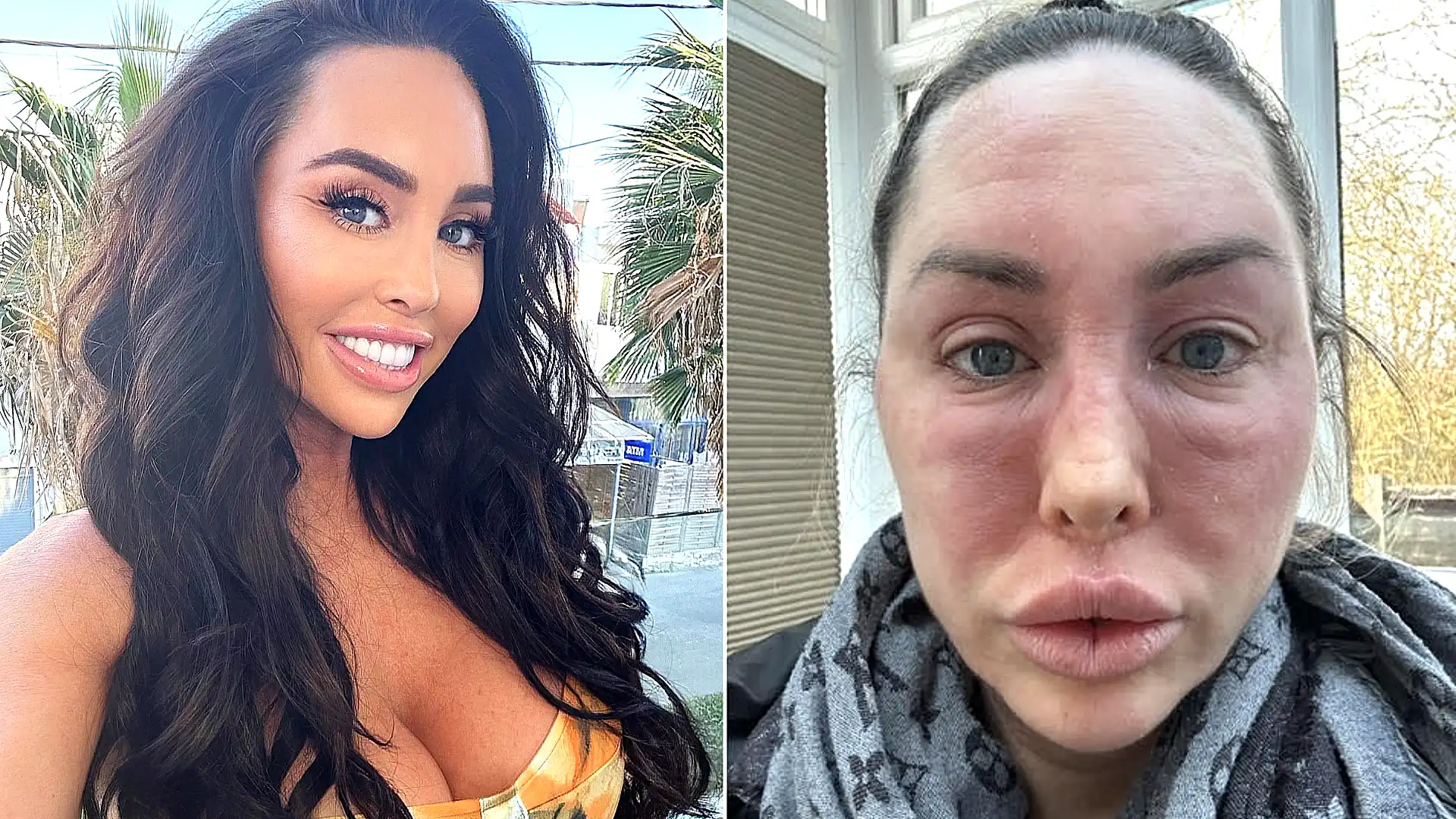 ‘I was a bikini model in beauty pageants - until a common skin cream made me 'look like Freddy Krueger'’