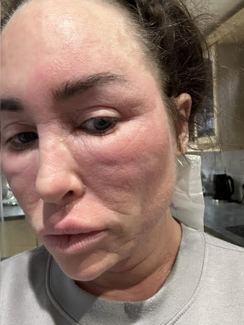 Bikini model prescribed a common eczema cream since childhood says topical steroid withdrawal has left her 'looking like Freddy Krueger' - bedbound, hospitalised and in agony.