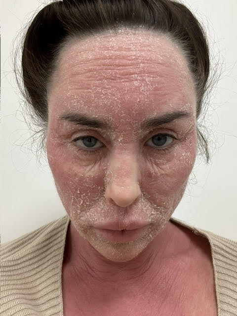 Bikini model prescribed a common eczema cream since childhood says topical steroid withdrawal has left her 'looking like Freddy Krueger' - bedbound, hospitalised and in agony.