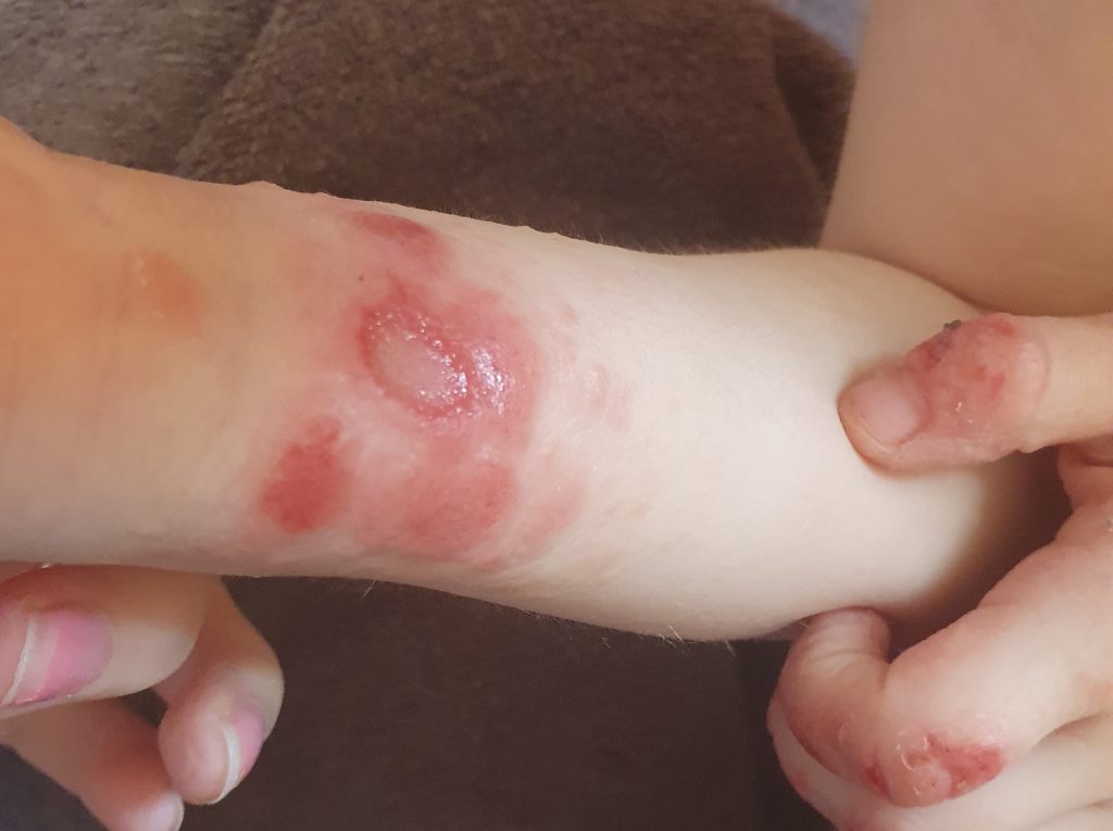 Little girl, 10, who couldn't smile because her agonising eczema left her skin cracking and bleeding has been given her childhood back after a pioneering NHS drug trial.