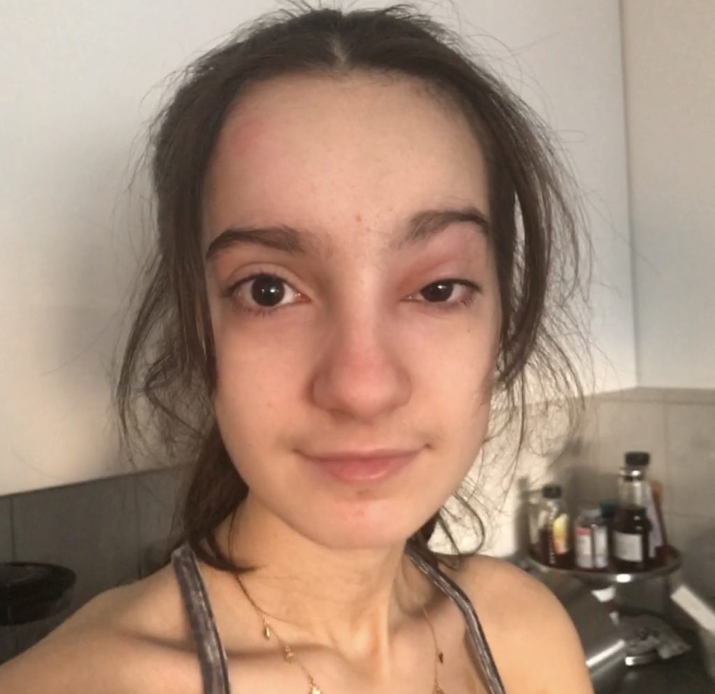 Michela Carbosiero was diagnosed with anorexia at 12 and warned she could suffer a cardiac arrest - now 22, she says gaining weight meant gaining her life back.