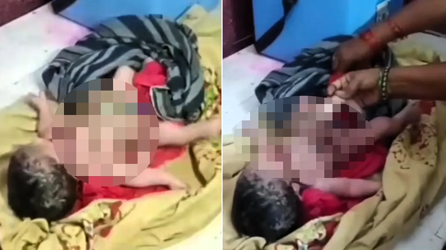 A newborn with four arms and four legs has left doctors stunned - with crowds gathering at the hospital to catch a glimpse of the extremely rare baby.