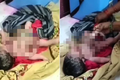 A newborn with four arms and four legs has left doctors stunned - with crowds gathering at the hospital to catch a glimpse of the extremely rare baby.