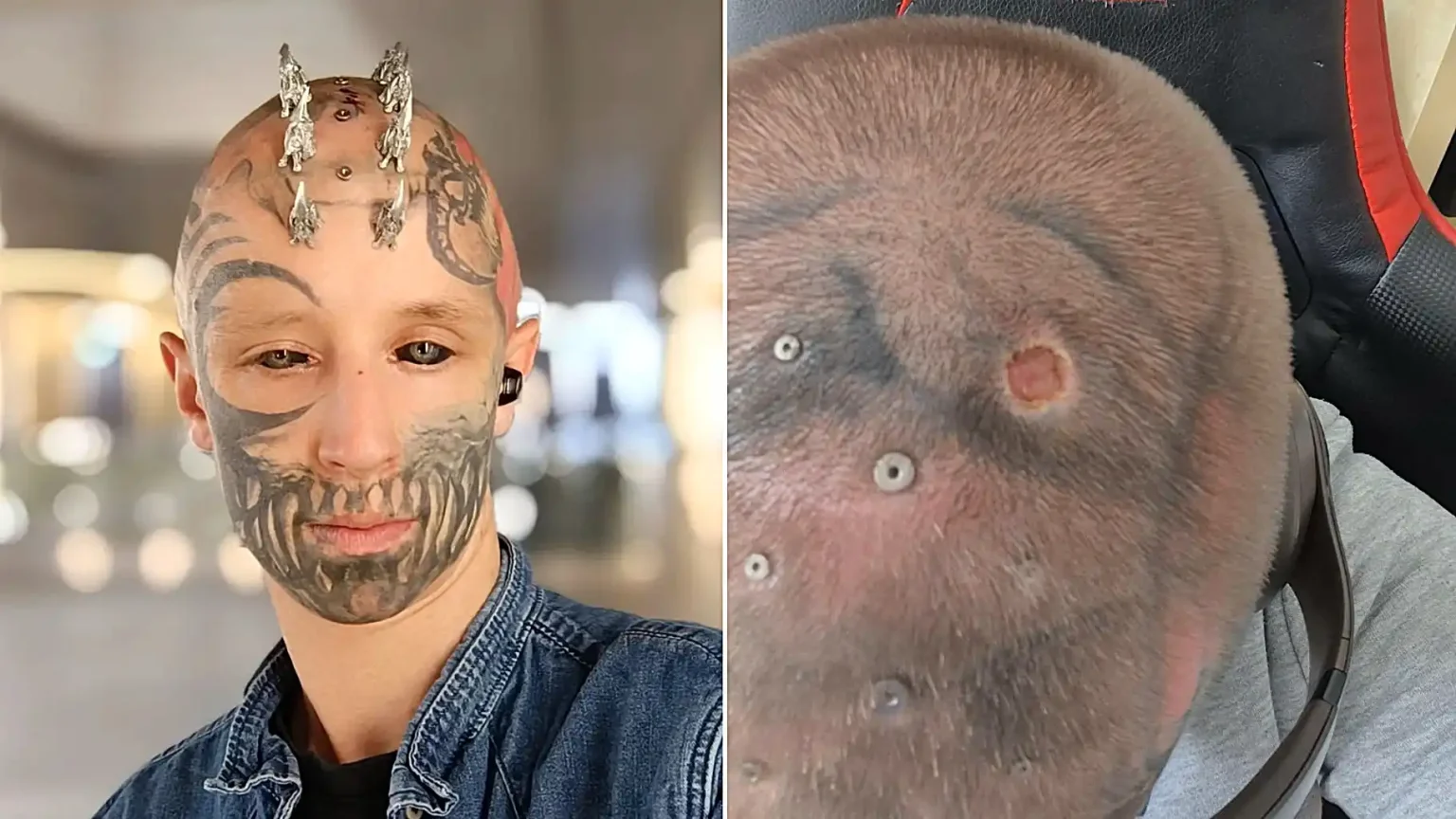 Blind man with tattooed black eyeballs reveals his extreme body mods turned into a nightmare after a metal head implant became so infected with pus it had to be surgically removed.