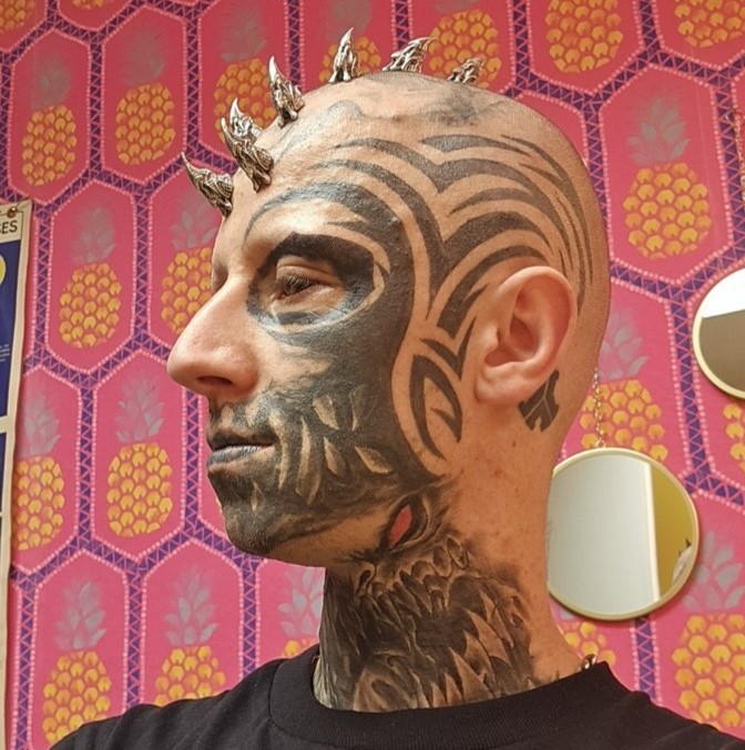 Blind man with tattooed black eyeballs reveals his extreme body mods turned into a nightmare after a metal head implant became so infected with pus it had to be surgically removed.