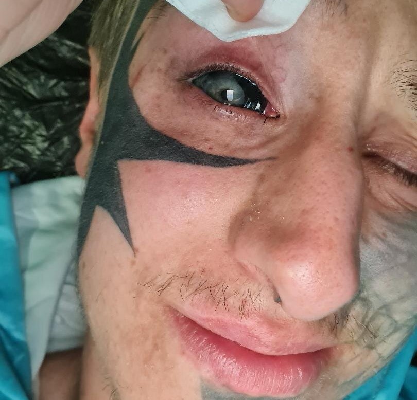 Blind man with tattooed black eyeballs reveals his extreme body mods turned into a nightmare after a metal head implant became so infected with pus it had to be surgically removed.