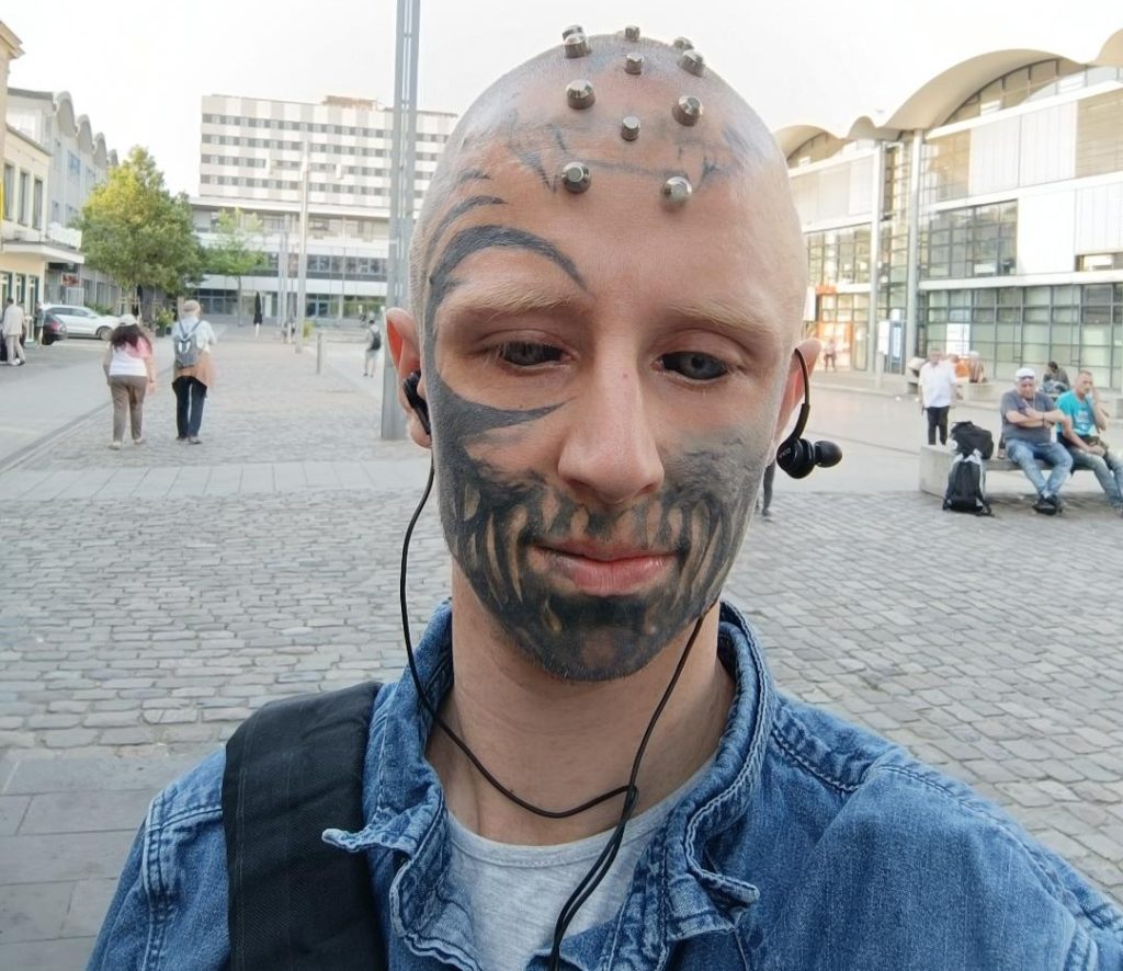 Blind man with tattooed black eyeballs reveals his extreme body mods turned into a nightmare after a metal head implant became so infected with pus it had to be surgically removed.