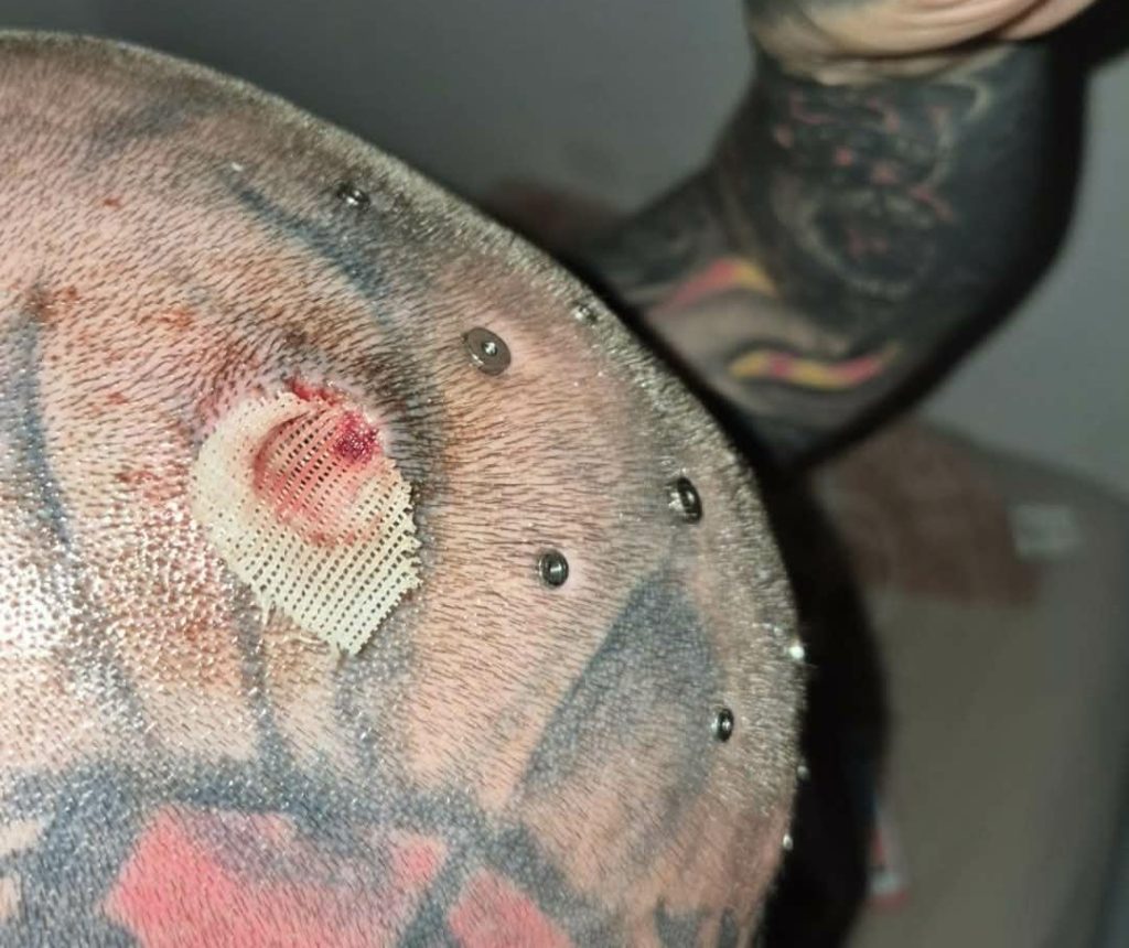 Blind man with tattooed black eyeballs reveals his extreme body mods turned into a nightmare after a metal head implant became so infected with pus it had to be surgically removed.
