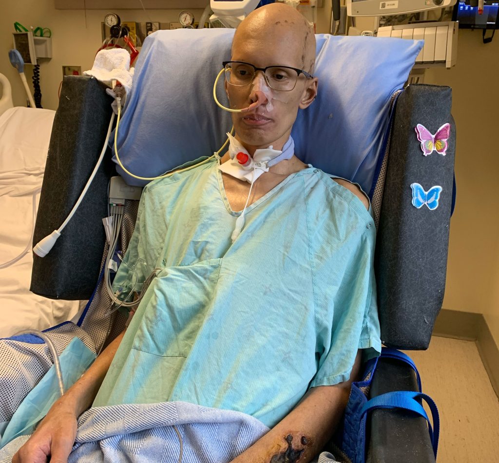Bodybuilder who survived a simple cold that turned into deadly organ failure has been dealt another blow as a rare genetic eye disease steals his sight - with no cure.