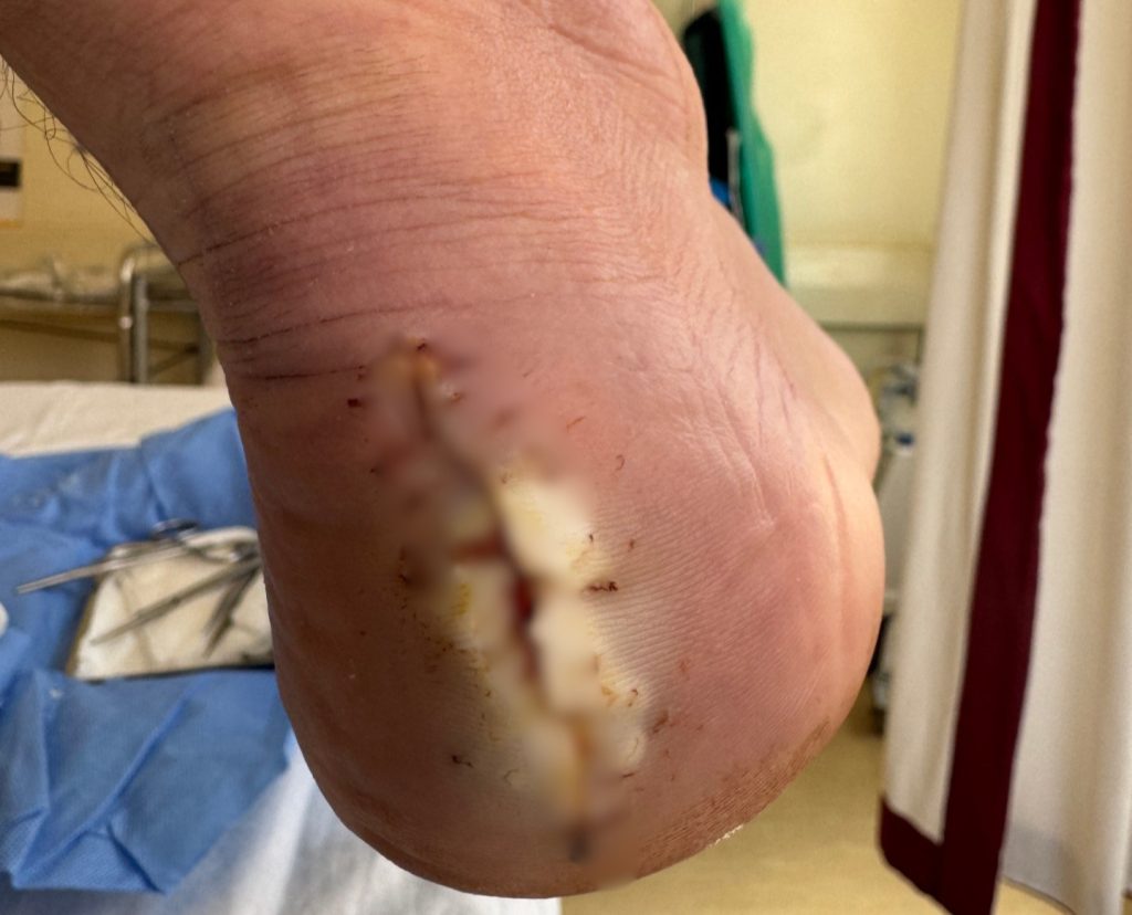 British travel influencer reveals how he drove 500km with a bullet lodged in his foot after being shot at by armed men during a terrifying road trip through Ethiopia.