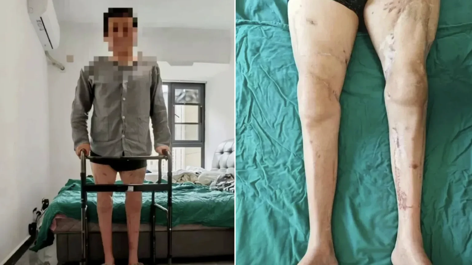 A factory worker whose legs were severed in a horror machinery accident has learned to walk again after doctors spent almost eight hours reattaching them.